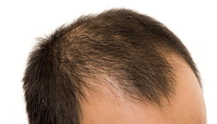 Hair Loss & Scalp Health Explained: Causes, Scalp Care, Hair Wellness & Expert Insights